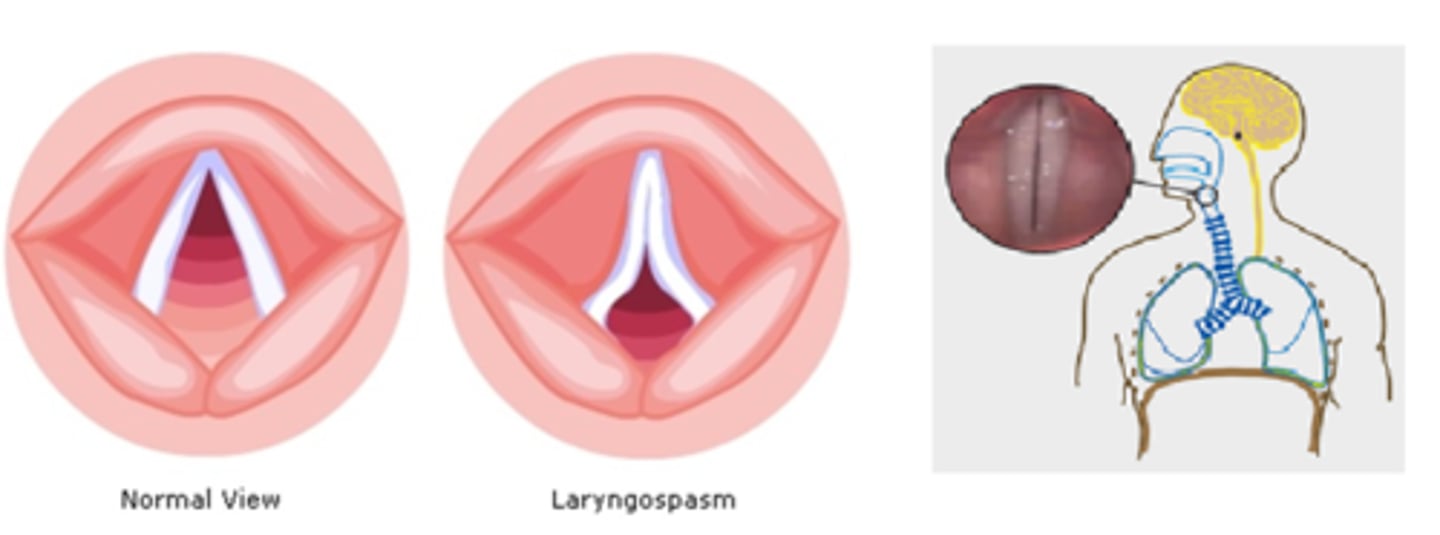 <p>definition: reflex protecting vocal cords, causing airway obstruction</p><p>signs: crowing sounds, labored breathing, suprasternal retraction (skin in middle of neck sucks in)</p><p>treatment: 100% O2, proper head position, suction, succinylcholine</p>