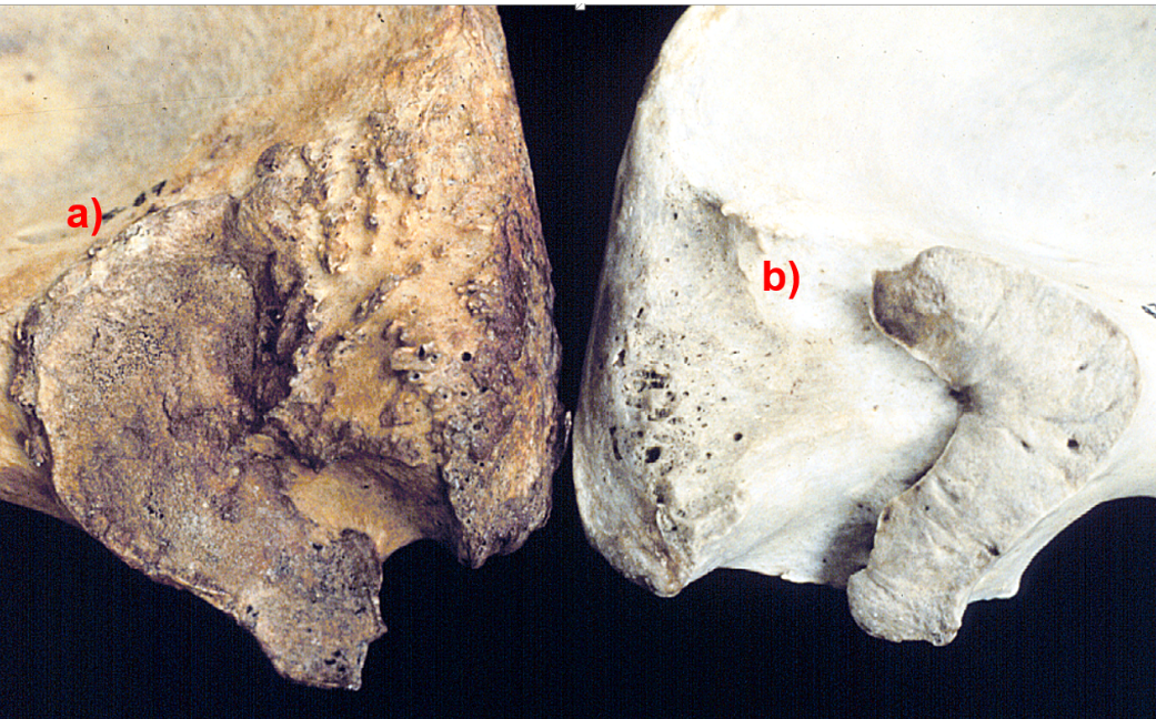 <p><span>Look at these two auricular surfaces, which one is from an older individual? Answer A or B, the letter must be capitalized in order to receive credit for your answer</span></p>