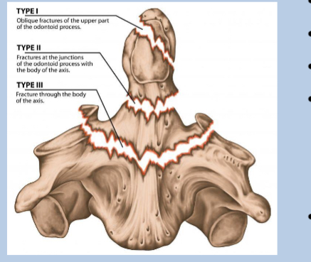 <p>Transverse through the base</p><p></p>