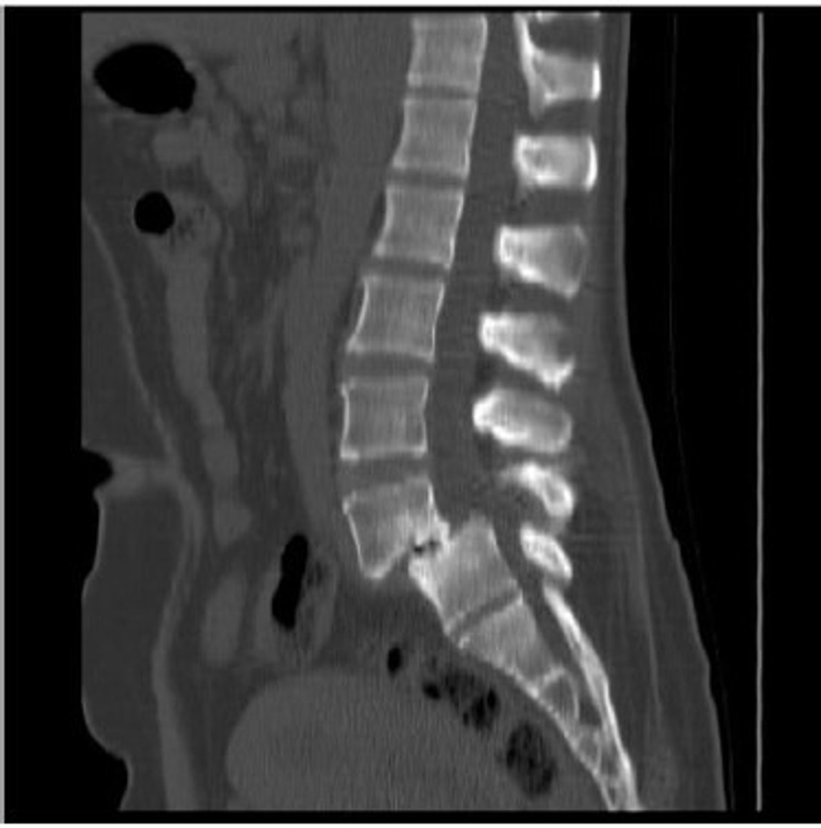 <p>Spondylolisthesis</p><p>Answer: A. Stork standing test</p><p>B. Gillet test - SI clusters</p><p>C. Van Gelderen bicycle test - spinal stenosis</p>