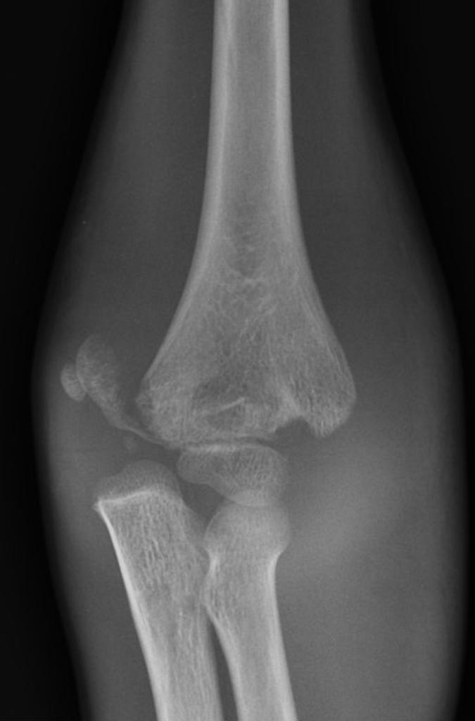 <p>A six year old boy presents to the emergency department following a fall from the monkey bars.</p><p>Clinical examination demonstrates tenderness, significant swelling and deformity of the left elbow.</p>