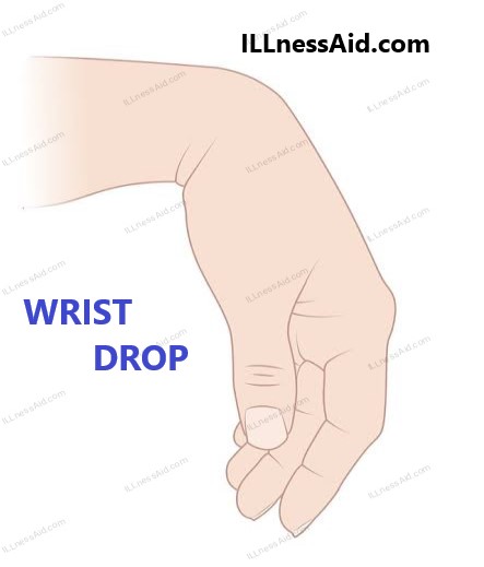 <p>-Radial nerve palsy</p><p>-Wrist extensors can’t oppose wrist flexion</p>