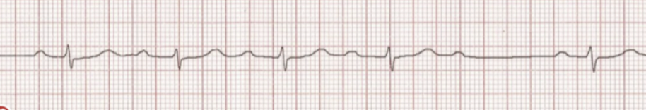 <p>Identify what type of heart block is shown! Discuss symptoms </p>