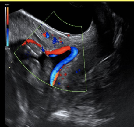 <p>what are the expected US finding in vasa previa</p><p>a) the internal os is covered by a large blood clot caused by placenta abruption</p><p>b) the internal os is covered by the umbilical vessel attachment to a low lying or marginal placenta</p><p>c) the internal os is completely covered by the base of the placenta</p><p>d) placenta percreta where the endometrium has invaded the myometrium + serosa causing hemorrhage </p>