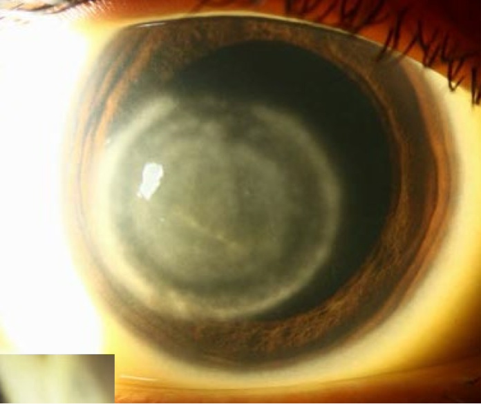 <ul><li><p><span><strong>Cause</strong>: immune response to viral antigen</span></p></li><li><p><span><strong>Symptoms</strong>:</span></p><ul><li><p><span>Gradual onset of blurred vision with associated glare around lights</span></p></li><li><p><span>Discomfort-less than with epithelial disease</span></p></li><li><p><span>Hyperemia-less than with epithelial disease</span></p></li></ul></li><li><p><span><strong>Presentation:</strong></span></p><ul><li><p><span>Disc-shaped stromal edema located in the center of the cornea</span></p></li><li><p><span>Epithelium will be intact</span></p></li><li><p><span>Mild anterior uveitis</span></p></li><li><p><span>Granulomatous keratic precipitates</span></p></li><li><p><span>Immune ring of stromal haze (Wessely ring)-signifies deposition of viral antigen and host antibody complexes</span></p></li><li><p><span>Increased IOP d/t trabeculitis</span></p></li></ul></li><li><p><span><strong>Treatment</strong>:</span></p><ul><li><p><span>Topical corticosteroid</span></p></li><li><p><span>Topical antiviral</span></p></li><li><p><span>Topical cycloplegic (provide comfort due to AC reaction)</span></p></li></ul></li></ul><p></p>