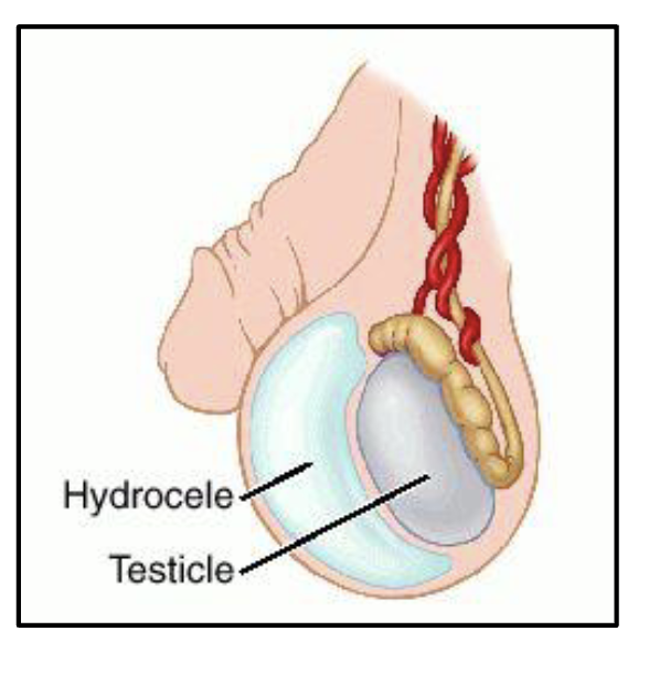 <ul><li><p>Accumulation of fluid around a testicle, this is relatively common</p></li><li><p>caused by fluid secreted from the tunica vaginalis</p></li><li><p>a simple method of diagnosing a hydrocele vs a tumor is to shine a strong light through the enlarges scrotum</p><ul><li><p>hydrocele will usually allow light to pass</p></li></ul></li></ul><p></p>