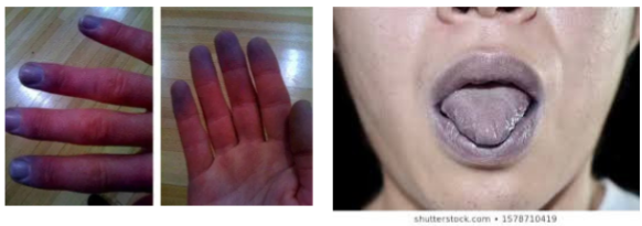 <ul><li><p>When hemoglobin is poorly oxygenated, giving the skin a bluish-gray tint.</p></li><li><p>especially obvious in the oral mucous membranes and nail beds, particularly in darker-skinned individuals.</p></li><li><p>can be a sign of respiratory or cardiovascular problems.</p></li></ul><p></p>