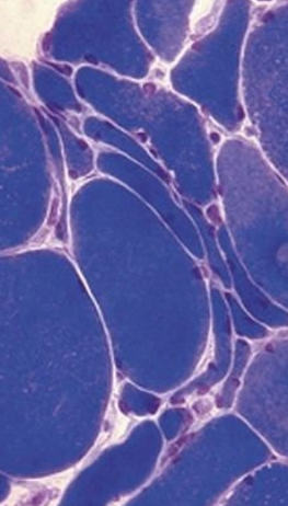 A 55-year-old man has repeated trauma to his upper arms from operating a jackhammer. He now has hand and forearm weakness. A skeletal muscle biopsy specimen reveals the pattern shown at the right. What is the microscopic description of these myocytes? What features support the diagnosis?  Why are smaller angulated fibers grouped together?  