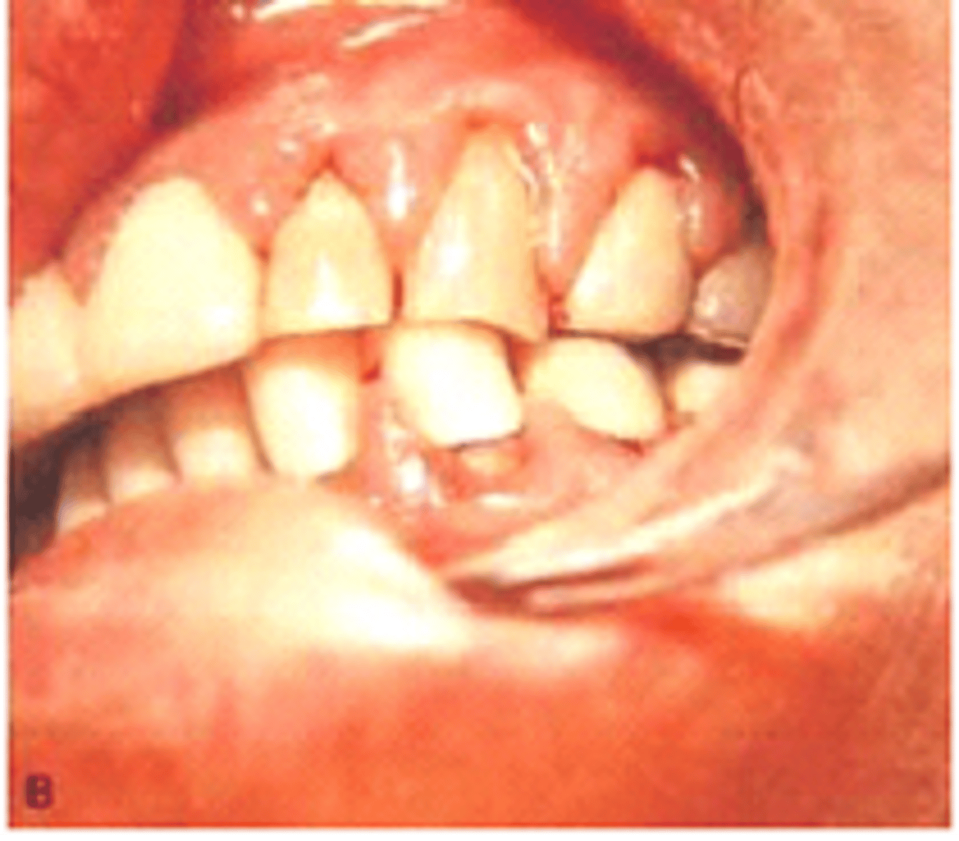 <p>Gingival Enlargement by a calcium channel Blocker</p>