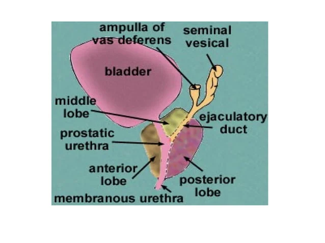 <p>C. ejaculatory duct</p><p><strong>ejaculatory ducts</strong> open into the <strong>posterior wall of the prostatic urethra</strong> at the <strong>seminal colliculus</strong></p><ul><li><p>During surgery to remove hypertrophic prostate tissue affecting the <strong>prostatic urethra</strong>, the <strong>posterior wall</strong> may be partially removed, potentially damaging the ejaculatory ducts.</p><ul><li><p class=""><strong>duct of seminal vesicle</strong> joins the ductus deferens to form the ejaculatory duct but does not open directly into the urethra.</p></li><li><p class="">The <strong>ductus deferens</strong> leads to the ejaculatory duct but does not open into the urethra itself.</p></li><li><p class="">The <strong>fossa navicularis</strong> is part of the penile urethra, distal from the prostate.</p></li><li><p class="">The <strong>seminiferous tubules</strong> are inside the testes and unrelated to this surgery.</p></li></ul></li></ul><p></p>