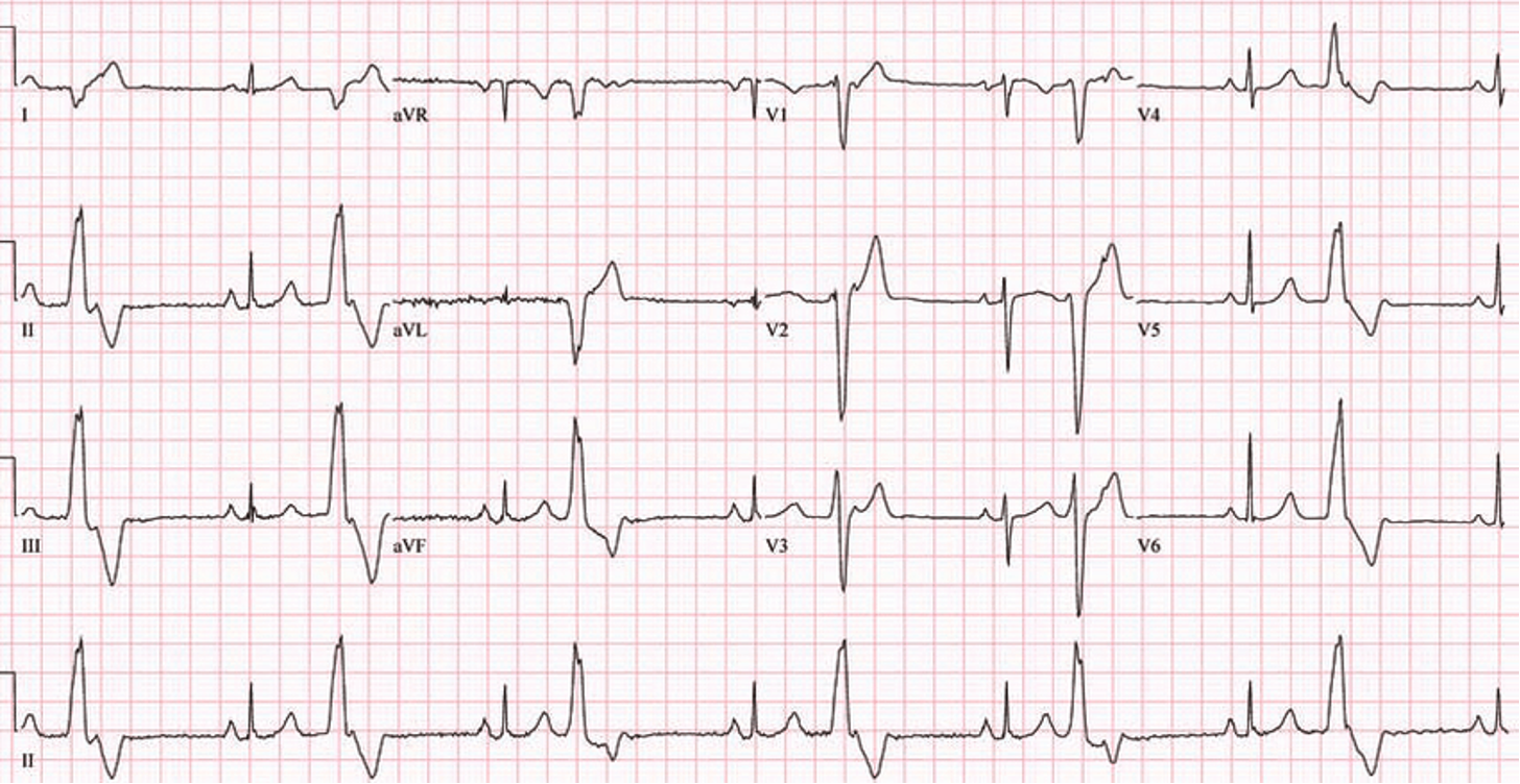 <p>What does this refer “PVCs alternating with sinus beats”</p>