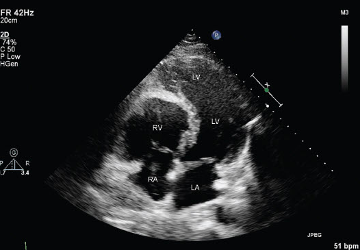 <p><span>Uhl Disease may demonstrate a 'banana' shaped LV such as this image below:</span></p>