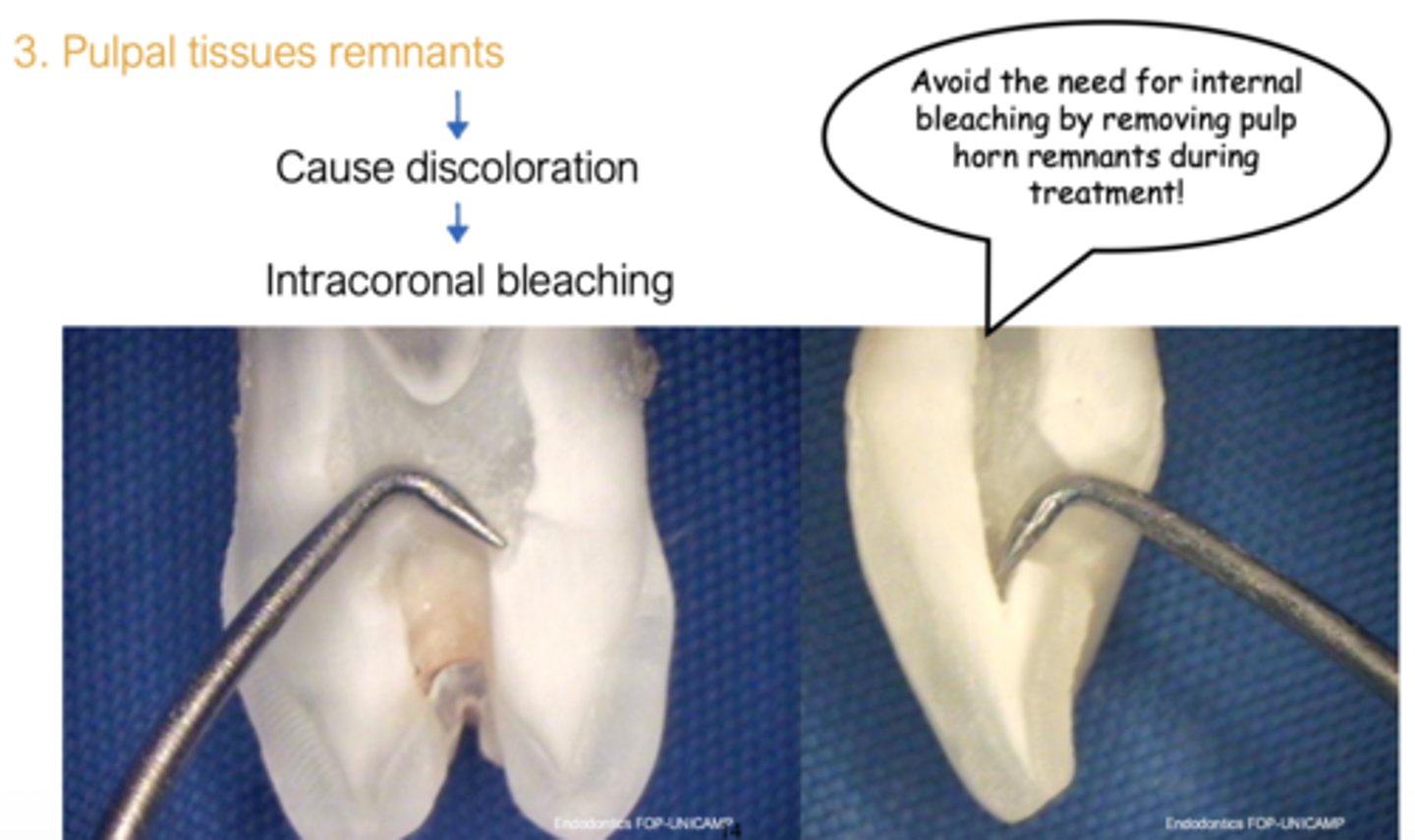 <p>By removing pulp horn remnants during treatment!</p>