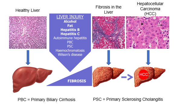 <ul><li><p>Histology: large nuclei = metabolically active</p></li><li><p>Fibrosis is a commonality of liver injury</p></li><li><p>Fibrotic tissue is non functional and contracts to prevent blood supply to hepatocytes</p></li><li><p>HCC = hepatocellular carcinoma: primary tumour in liver</p></li></ul><p></p>
