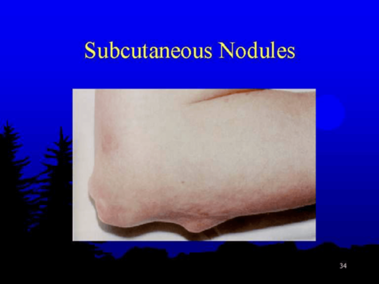 <p>Twenty percent of patients have subcutaneous rheumatoid nodules, most commonly situated over bony prominences but also observed in the bursae and tendon sheaths</p>