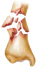 <p>fracture</p>