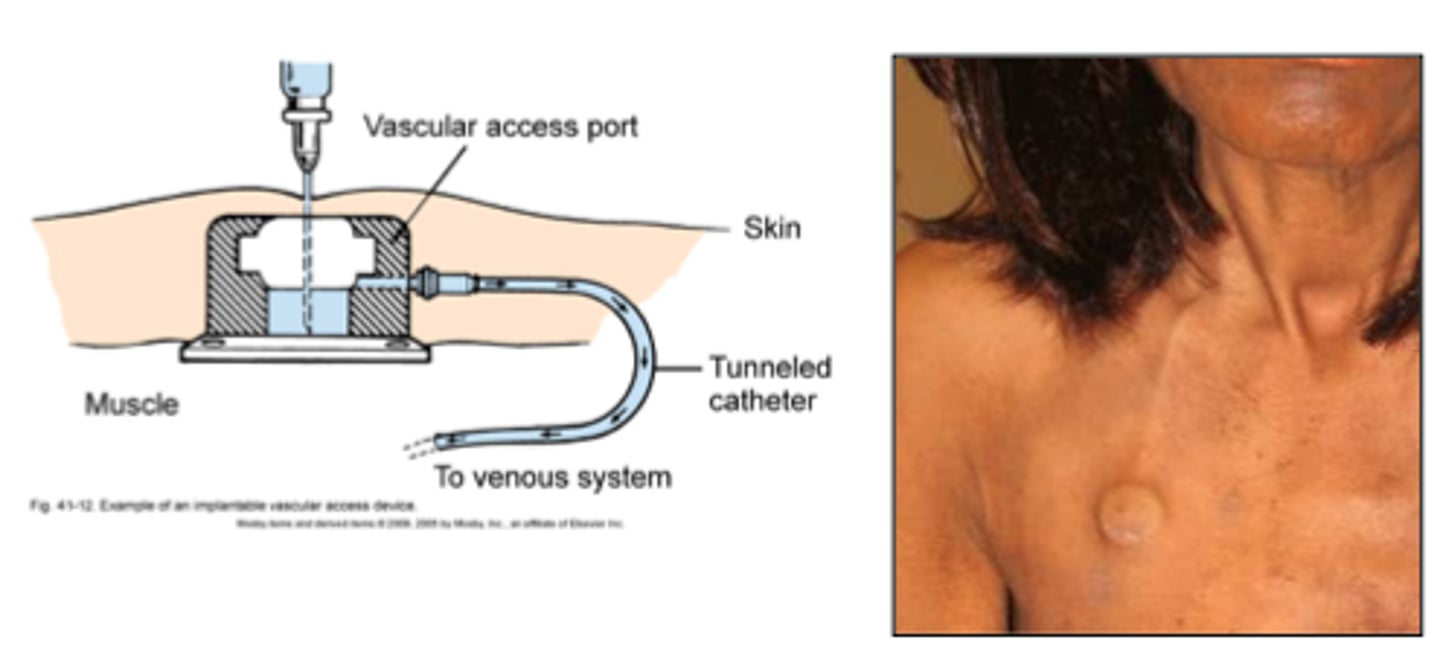 <p>Not visible (completely under skin)</p><p>Needle access through skin</p><p>Maintenance minimal when not accessed</p><p>Lower infxn risk</p><p>Ideal for intermittent chemo, outpatient use</p>
