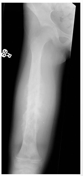 <p>12yo girl with thigh pain for 2 months, worsening in past 10 days with a low fever for 1 week. <strong>what is it and what is the most consistent natural history of this disease?</strong></p>
