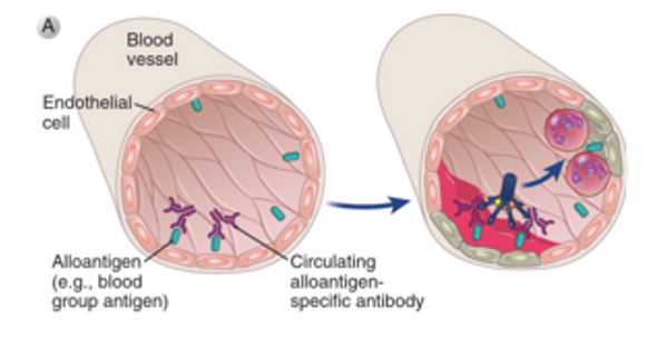 <p>Due to <mark data-color="purple" style="background-color: purple; color: inherit;">pre-existing antibodies</mark> to donor antigens (e.g. HLA, blood group antigens)→ <strong>second-set rejection</strong></p><p>Pre-existing <strong>recipient antibodies</strong> bind to donor endothelial cells → <strong>complement activation and ADCC</strong> → vascular damage, thrombosis.</p>