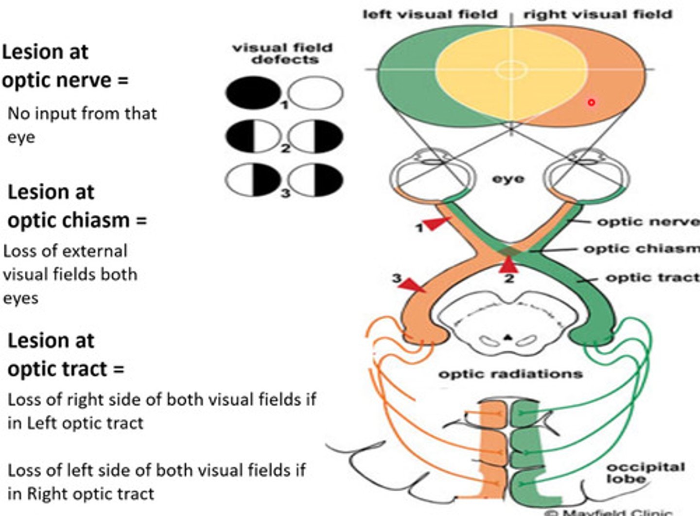 <p>Optic N: No input from that eye</p><p>Chiasm: Loss of external visual fields from both eyes (Nasal retina)</p>