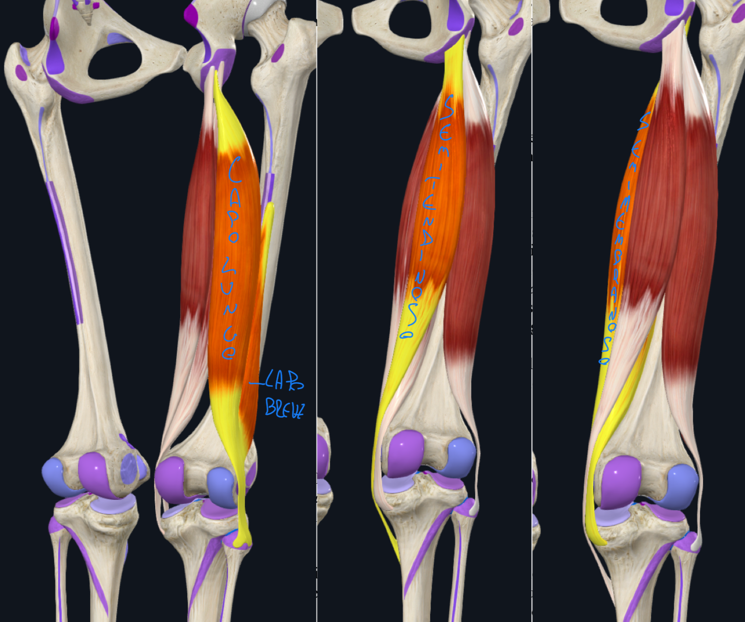 <p>MUSCOLO BICIPITE FEMORALE:</p><ul><li><p>Capo Lungo → origina dalla tuberosità ischiatica</p></li><li><p>Capo Breve → origina dal terzo medio del labbro laterale della linea aspra</p></li><li><p>Inserzione comune → apice della testa della fibula, decorrendo lateralmente all’articolazione del ginocchio</p></li><li><p>Funzione:</p><ul><li><p>Estensione coscia (capo lungo)</p></li><li><p>Flessione e rotazione laterale gamba</p></li></ul></li><li><p>Innervazione;</p><ul><li><p>Nervo Tibiale per capo lungo</p></li><li><p>Nervo Fibulare Comune per capo breve</p></li><li><p>Rami del nervo ischiatico o sciatico che dalla regione glutea si separa a livello della fossa poplitea</p></li></ul></li></ul><p>MUSCOLO SEMITENDINOSO:</p><ul><li><p>Origine → Tuberosità Ischiatica</p></li><li><p>Inserzione → medialmente alla tuberosità tibiale</p></li></ul><p>MUSCOLO SEMIMEBRANOSO:</p><ul><li><p>Origine → Tuberosità Ischiatica</p></li><li><p>Inserzione → posteriormente al condilo mediale della tibia</p></li><li><p>Passando dietro al ginocchio, invia un’espansione fibrosa → il legamento popliteo obliquo che rinforza la capsula del ginocchio</p></li></ul><p>Funzione di entrambi (semitendinoso e semimembranoso):</p><ul><li><p>Estensione coscia</p></li><li><p>Flessione e rotazione mediale gamba</p></li></ul><p>Innervazione di entrambi → nervo tibiale</p><p></p><p>N.B.</p><ul><li><p>Capo lungo bicipite femorale, semitendinoso e semimebranoso fanno parte dei muscoli ischiocrurali → termine che indica che originano dalla tuberosità ischiatica e raggiungono le ossa della gamba (crura)</p></li></ul><p></p>