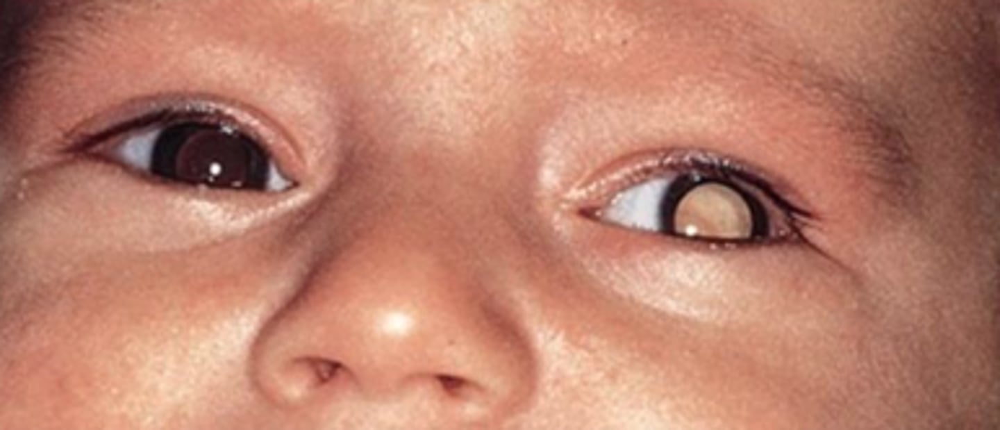 <p>D. Retinoblastoma</p><p>* Retinoblastoma is a disease in which malignant (cancer) cells form in the tissues of the retina.</p>