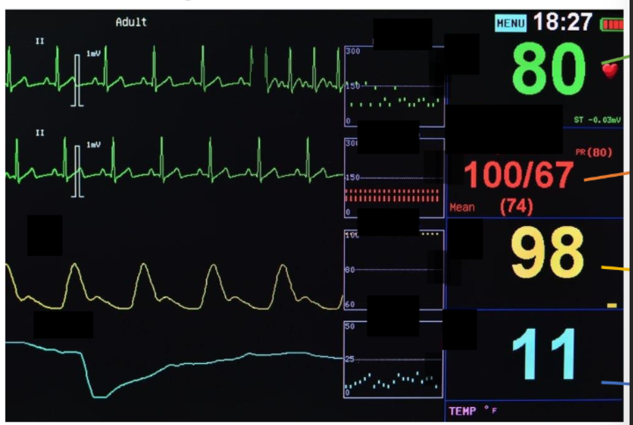 <p>numbers on this (top to bottom)</p><ul><li><p>heart rate</p></li><li><p>bp</p></li><li><p>oxygen saturation</p></li><li><p>respiratory rate</p></li></ul><p></p>