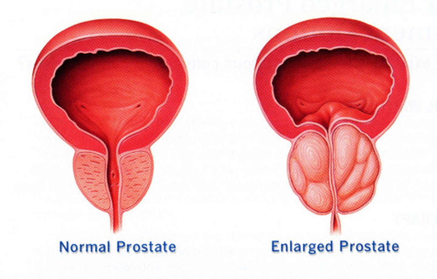 <p>A benign growth of cells within the prostate gland, develops in 90% of men over 80 yrs old</p>