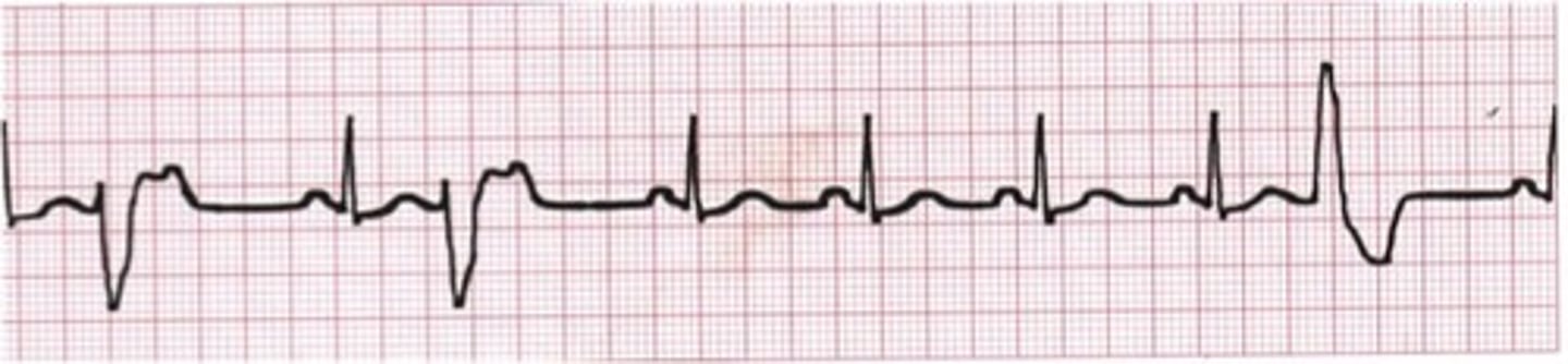 <p>Premature ventricular contraction</p>