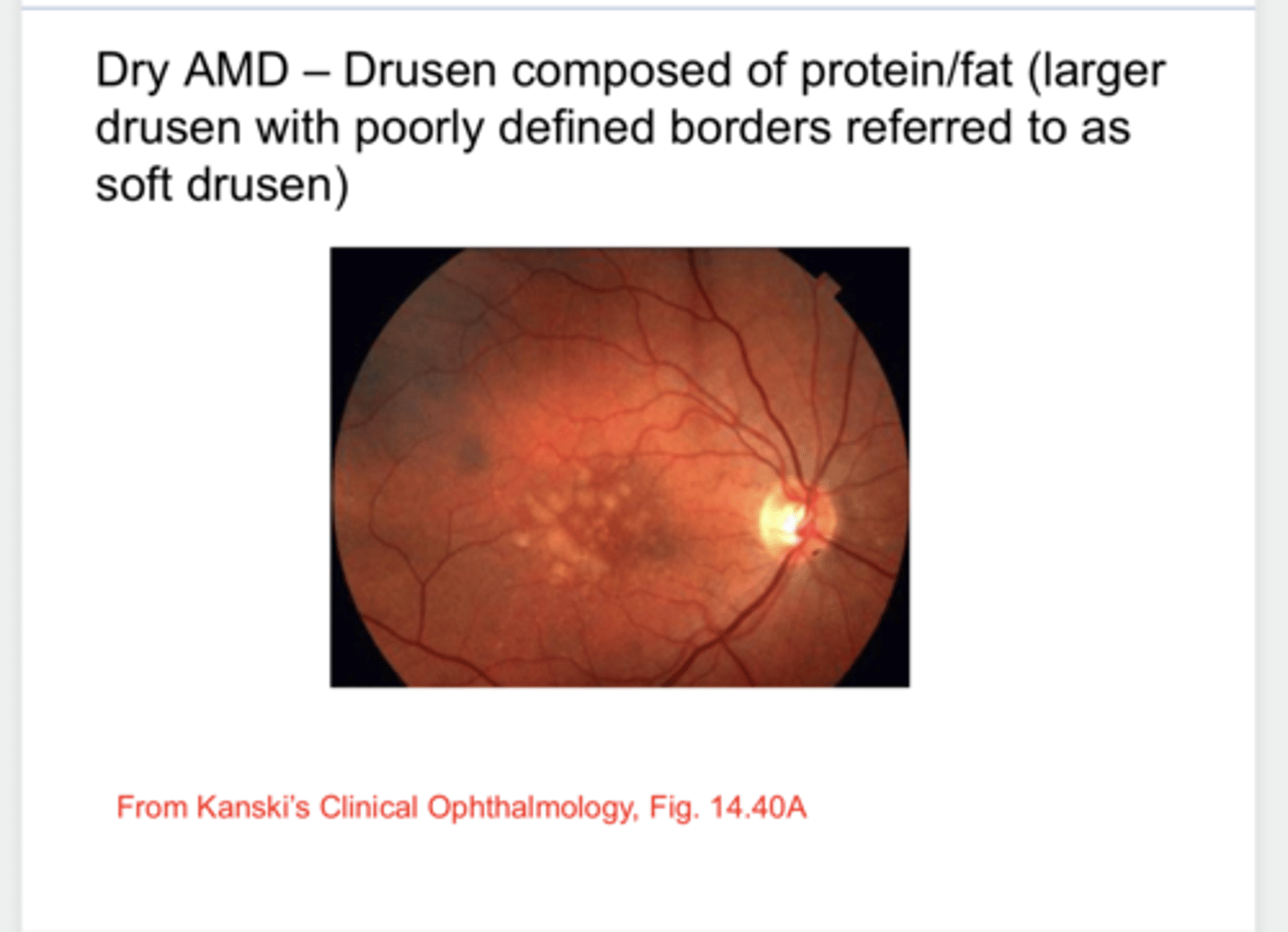 <p>What are drusen composed of?</p>