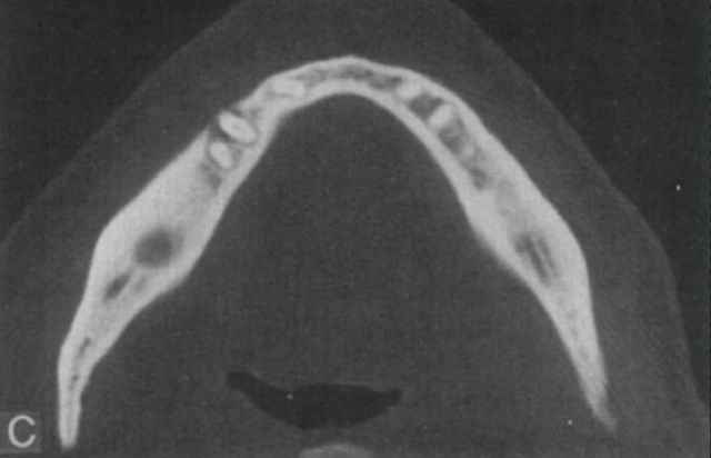 <p>bone infection with mostly <strong>SCLEROTIC</strong> reaction</p>