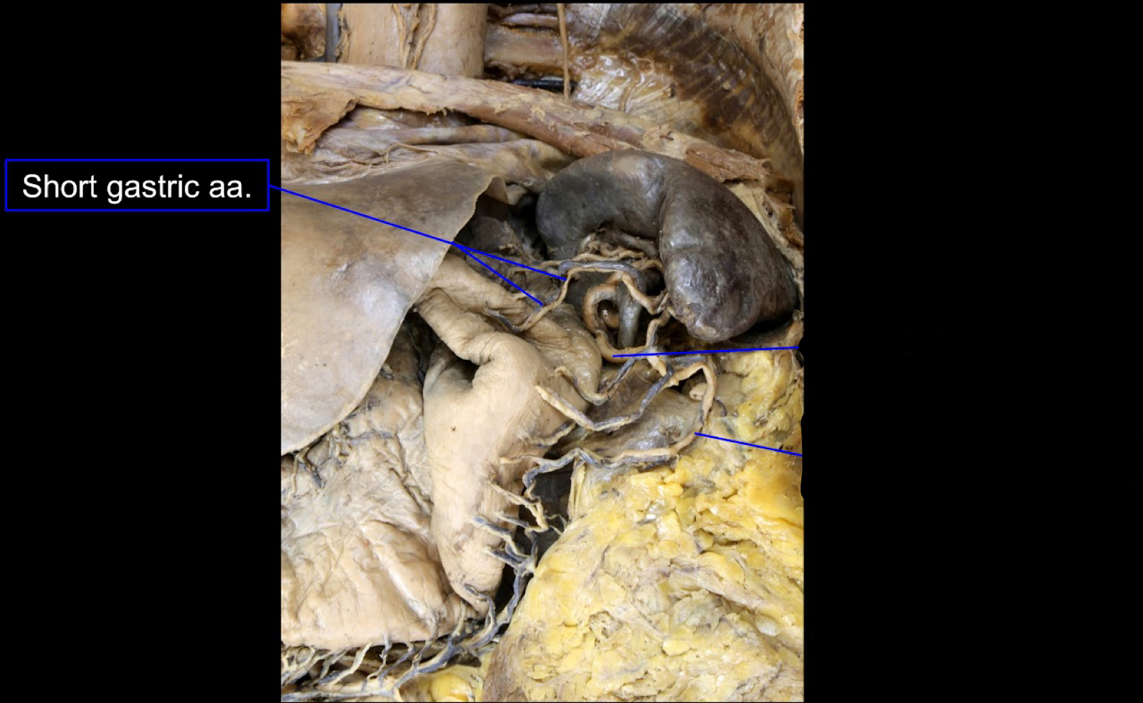 <p>A). short gastric arteries<br>B). splenic artery<br>C). fundus of the stomach</p>