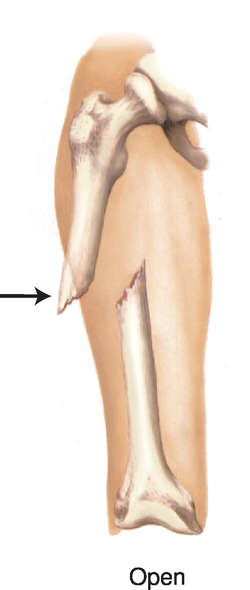 <p>The broken ends of the bone protrude through the skin.</p>