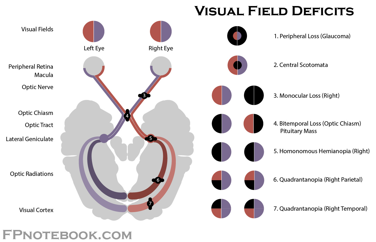 <p>#4: Bitemporal hemianopia (Tunnel vision) </p>