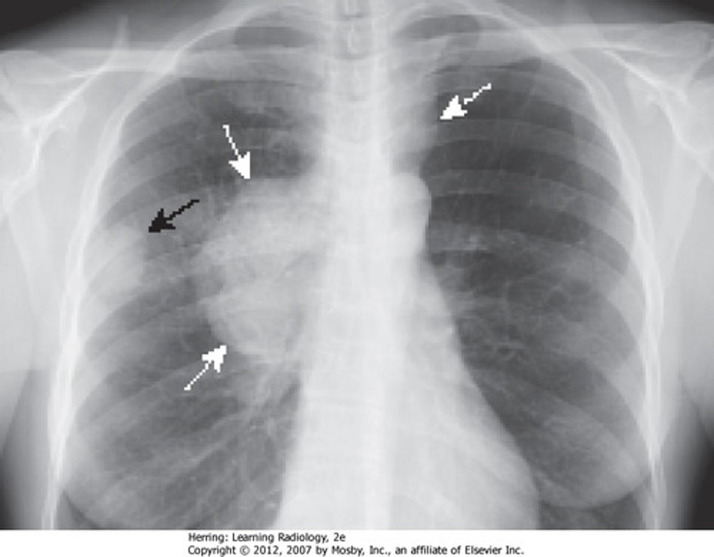 <p>bronchogenic carcinoma</p>