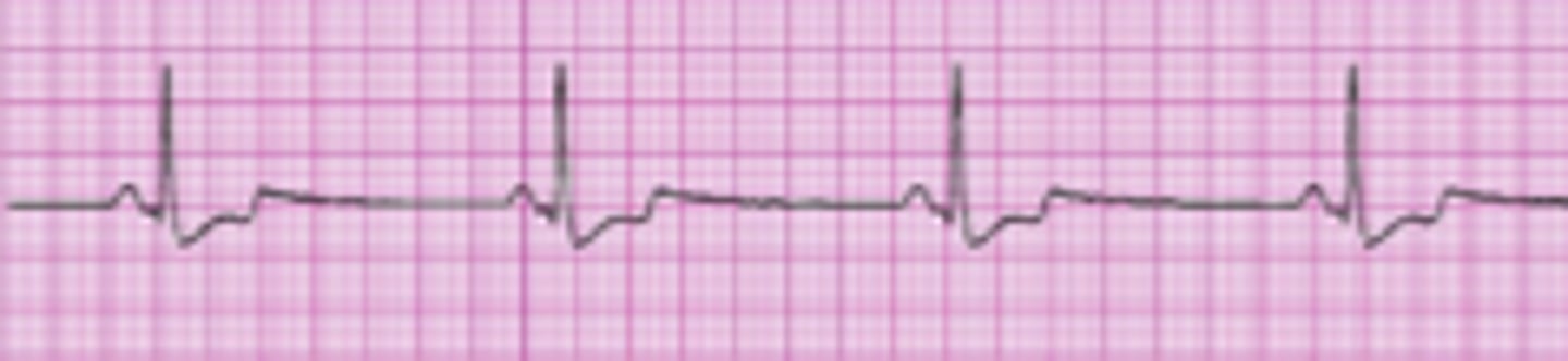 <p>- &lt;60 bpm</p><p>- Common causes: weakened or damaged SA node, hypoxemia, increased ICPs, OSA.</p><p>- Severe cases: decreased CO, BP, and tissue hypoxia.</p><p>- poor capillary refill, cold, clammy and depressed sensorium. </p><p>- Treatment: Atropine and oxygen</p>