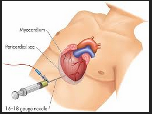 drainage of fluid from the pericardial cavity; Is usually necessary to relieve cardiac tamponade