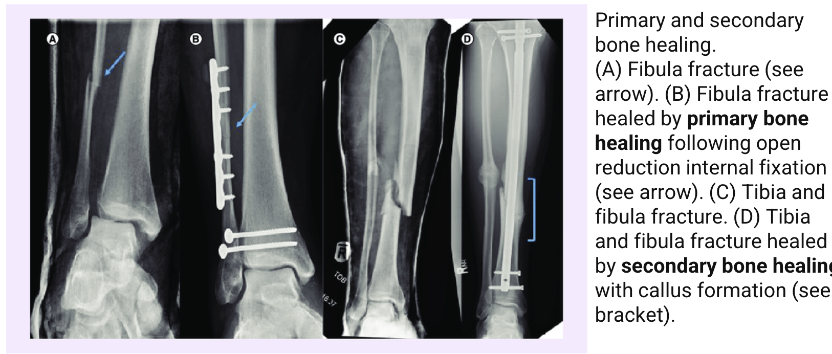 <p>secondary bone healing</p>