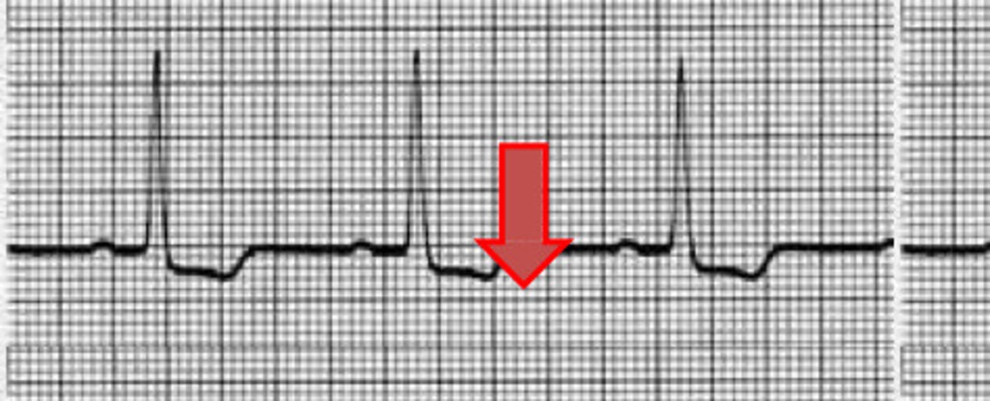 <p>What condition does this ECG indicate</p>
