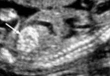 <ol><li><p>What pathology is seen at the white arrow?</p></li><li><p>Name at least 1 pathology question 1’s answer can be associated with.</p></li></ol><p></p>