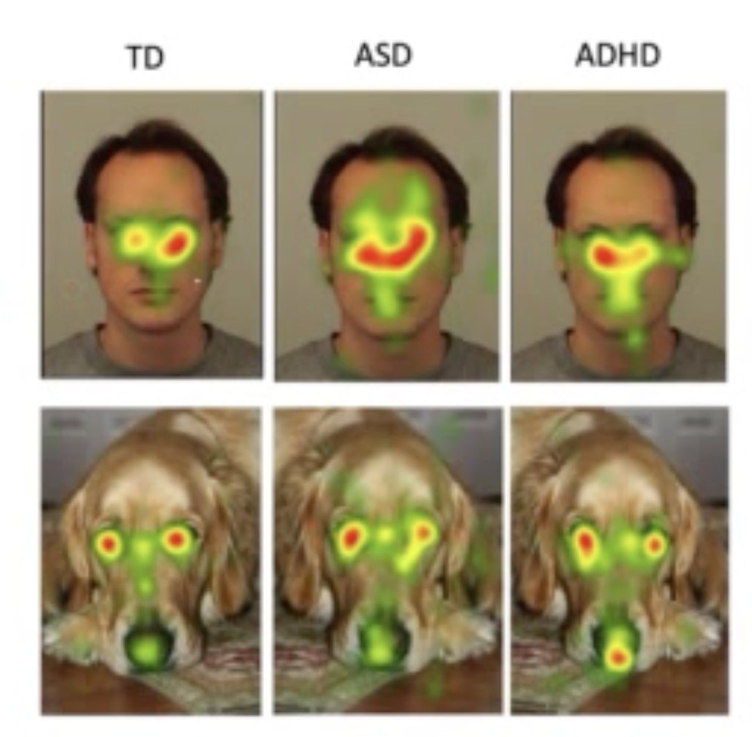 <p>They compared face scanning between people with ADHD, ADD or TD when looking at dogs or humans</p><p>Found that:</p><ul><li><p>ADD and ADHD kids spent less time viewing the eye region than other regions of the face</p><ul><li><p>Supports that difficulties in processing social cues may be shared by both conditions</p></li></ul></li><li><p>People with ADHD had higher intellectual and adaptive functioning than people with ADD, but it didn’t impact the amount of time or region of interest</p></li></ul><p>Takeaway: People with ADD and ADHD are less likely to look people in the eye</p><p>Limitation: Lab based - is this generalisable?</p>