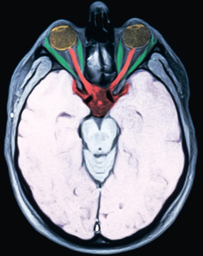 <p>Magnetic resource imaging (MRI)</p>