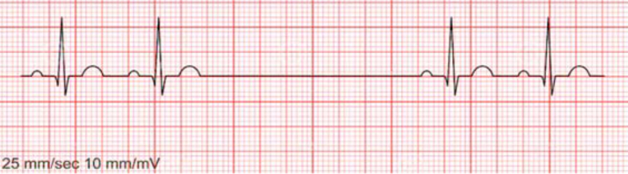 <p>SA node fails to initiate an impulse—missing P wave</p><p>P waves are normal, identical, occur before every QRS</p><p>PR interval normal</p><p>QRS complex is narrow, normal</p><p>R-R interval is regular except for when pause occurs</p><p>caused by sudden incr in para activity, diseased SA node, infection, digoxin toxicity</p><p>implications: long pauses can reduce CO and cause syncope</p>