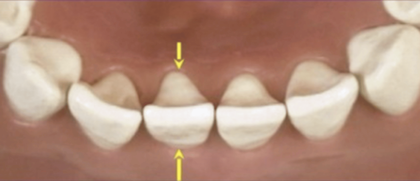 <p>- Centered CINGULUM= 4th lobe</p><p>- Mesial to Facial of contour centered</p>