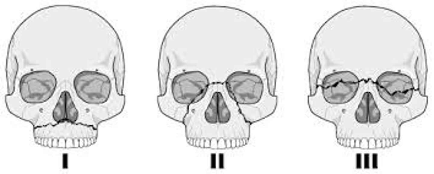 <p>le fort I fx</p><p>le fort II fx</p><p>le fort III fx- also known as cranio facial dislocation. the entire face is no longer attached to the skull. separtes the facial bones from the cranium</p><p>in patients with severe facial injuries, early trach is commonly performed (think Billy) for airway and secretion management</p>