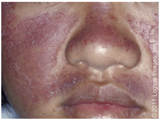 <p>What form of CLE is characterized by by a butterfly shaped rash across the cheeks and nose</p>