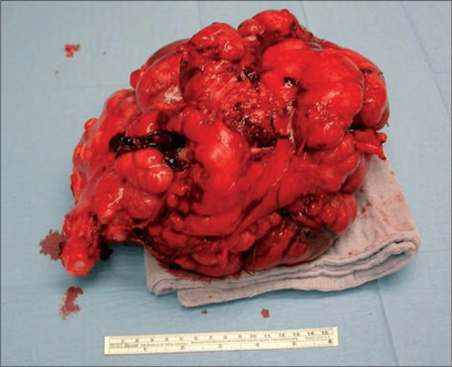 <p>A bulky mass that continues to enlarge after menopause, often accompanied by post-menopausal bleeding or pelvic pain.</p>