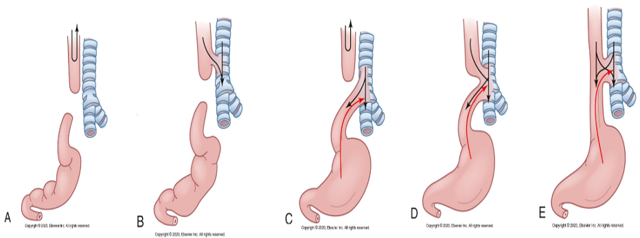 <p>- blind pouch</p><p>-tracheoesophageal fistulas </p><p>-Envi. and gen. risk factors</p><p>-Antenatal diagnosis = polyhydramnios, inability to pass gastric tube after birth</p><p>Signs: drooling, inability to swallow, respiratory distress</p><p>Tx: Place tube with suction</p><p>HOB elevated</p><p>no oral feedings to prevent aspiration</p><p></p>