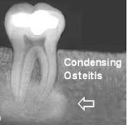 <p>is the tooth vital or non-vital in condensing osteitis</p>