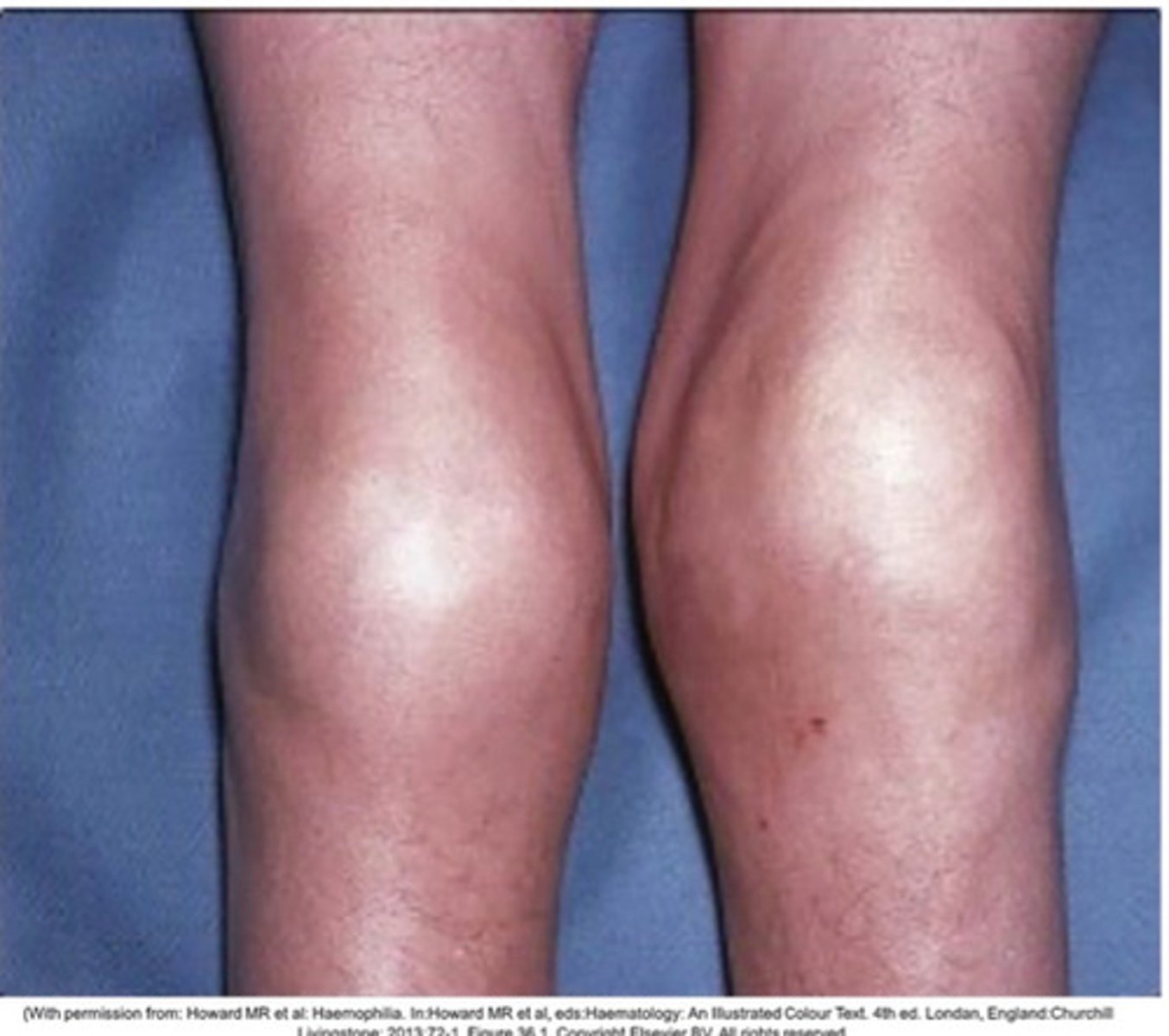 <p>*typically bilateral*</p><p>- knees (most common)</p><p>- elbows</p><p>- ankles</p><p>- hips</p><p>- shoulders</p>